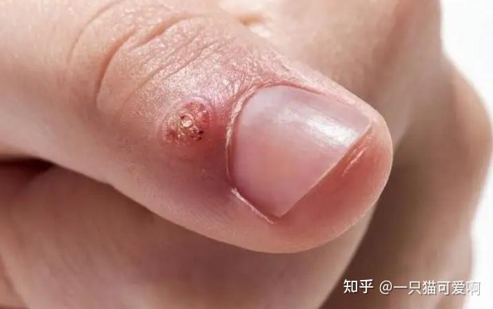 今日科普一下！5种疙瘩可能是HPV,百科词条爱好_2024最新更新