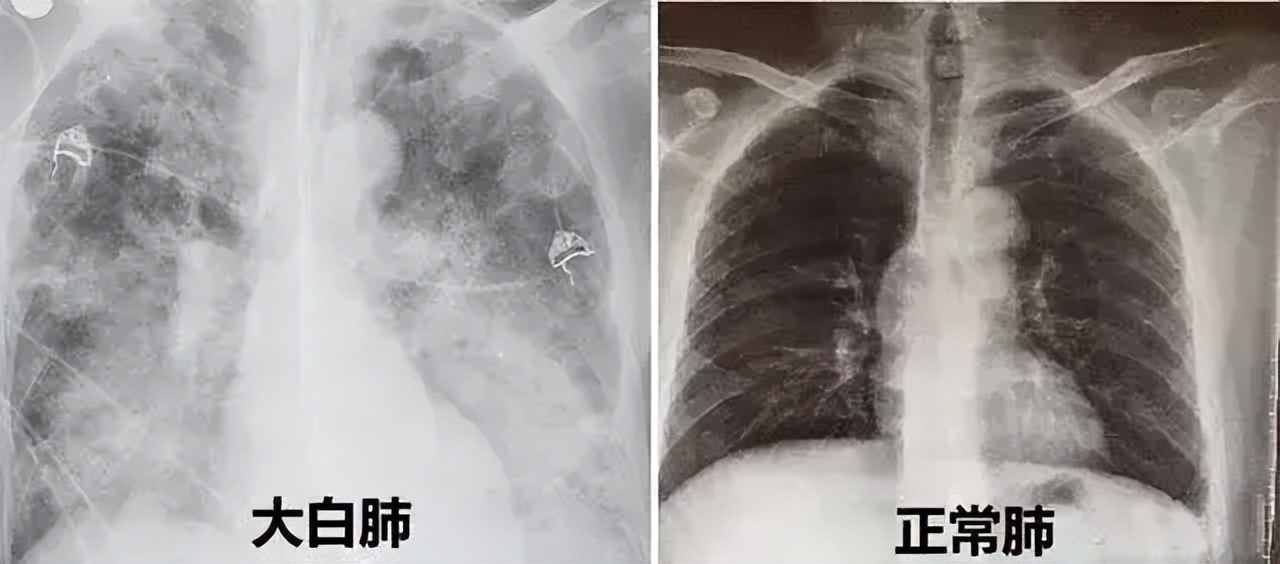 今日科普一下！流感后需警惕心肌炎,百科词条爱好_2024最新更新